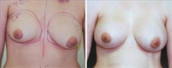 Breast Augmentation Patient Before & After Photo 1