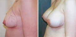 Breast Augmentation Patient Before & After Photo 1