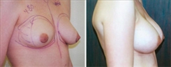 Breast Augmentation Patient Before & After Photo 1