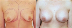 Breast Augmentation Patient Before & After Photo 1