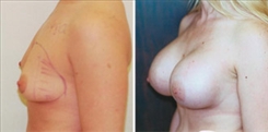 Breast Augmentation Patient Before & After Photo 1