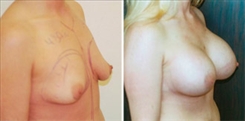 Breast Augmentation Patient Before & After Photo 1