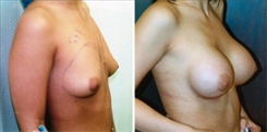 Breast Augmentation Patient Before & After Photo 1