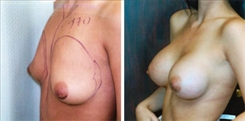 Breast Augmentation Patient Before & After Photo 1