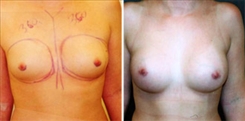 Breast Augmentation Patient Before & After Photo 1