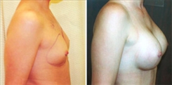 Breast Augmentation Patient Before & After Photo 1