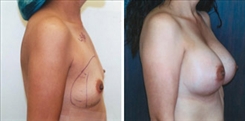 Breast Augmentation Patient Before & After Photo 1