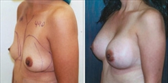 Breast Augmentation Patient Before & After Photo 1