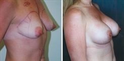 Breast Augmentation Patient Before & After Photo 1