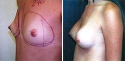 Breast Augmentation Patient Before & After Photo 1