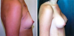 Breast Augmentation Patient Before & After Photo 1