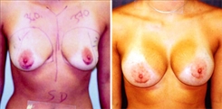 Breast Augmentation Patient Before & After Photo 1