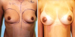 Breast Augmentation Patient Before & After Photo 1