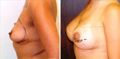 Breast Augmentation Patient Before & After Photo 1