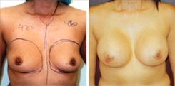 Breast Augmentation Patient Before & After Photo 1