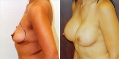 Breast Augmentation Patient Before & After Photo 1