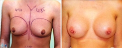 Breast Augmentation Patient Before & After Photo 1