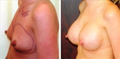 Breast Augmentation Patient Before & After Photo 1