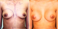 Breast Augmentation Patient Before & After Photo 1