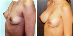 Breast Augmentation Patient Before & After Photo 1