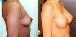 Breast Augmentation Patient Before & After Photo 1