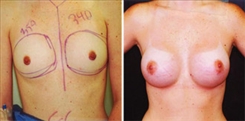 Breast Augmentation Patient Before & After Photo 1