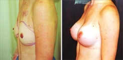 Breast Augmentation Patient Before & After Photo 1