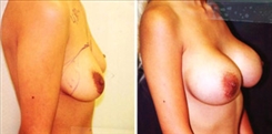 Breast Augmentation Patient Before & After Photo 1