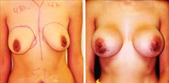 Breast Augmentation Patient Before & After Photo 1