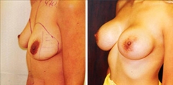 Breast Augmentation Patient Before & After Photo 1