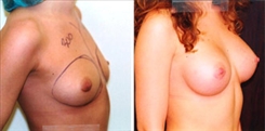 Breast Augmentation Patient Before & After Photo 1