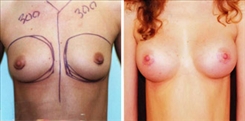 Breast Augmentation Patient Before & After Photo 1