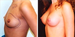 Breast Augmentation Patient Before & After Photo 1