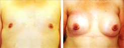 Breast Augmentation Patient Before & After Photo 1