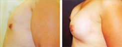 Breast Augmentation Patient Before & After Photo 1