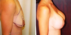 Breast Augmentation Patient Before & After Photo 1