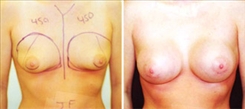 Breast Augmentation Patient Before & After Photo 1