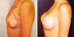 Breast Augmentation Patient Before & After Photo 1