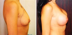 Breast Augmentation Patient Before & After Photo 1