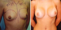 Breast Augmentation Patient Before & After Photo 1