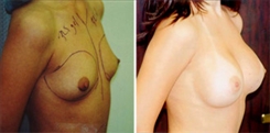 Breast Augmentation Patient Before & After Photo 1