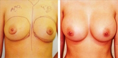 Breast Augmentation Patient Before & After Photo 1