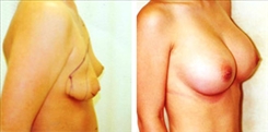 Breast Augmentation Patient Before & After Photo 1