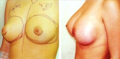 Breast Augmentation Patient Before & After Photo 1