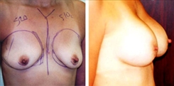 Breast Augmentation Patient Before & After Photo 1