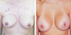 Breast Augmentation Patient Before & After Photo 1