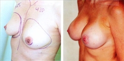 Breast Augmentation Patient Before & After Photo 1