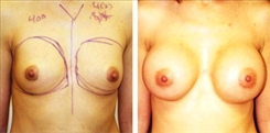 Breast Augmentation Patient Before & After Photo 1