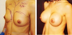 Breast Augmentation Patient Before & After Photo 1