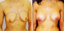 Breast Augmentation Patient Before & After Photo 1